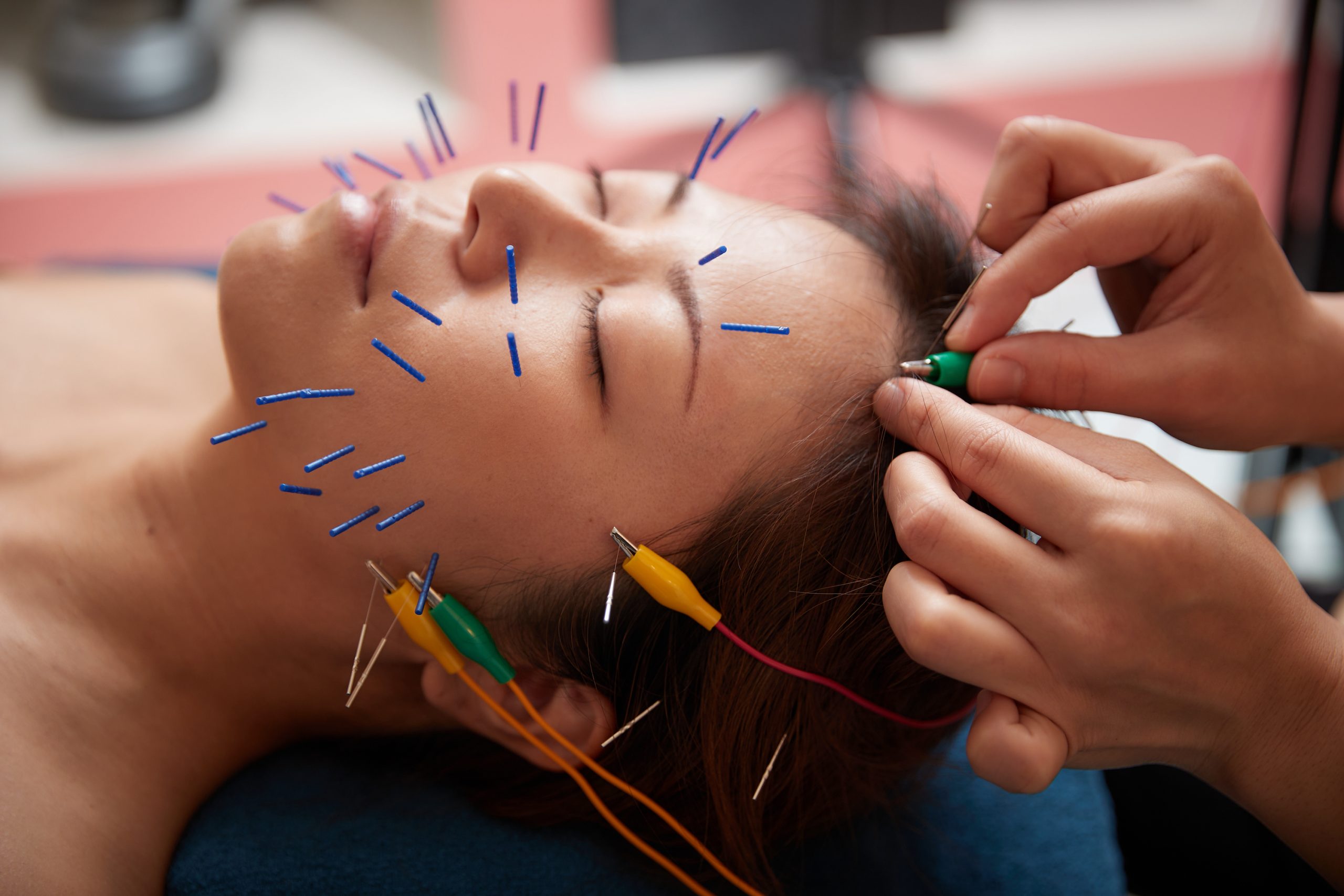 ご自宅で受けられる、プロの美容鍼